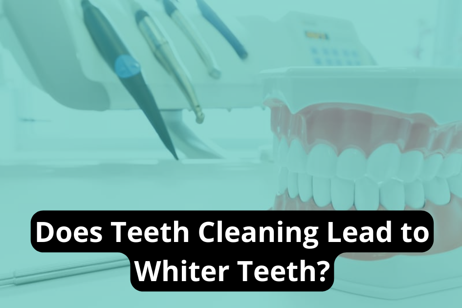 Does Teeth Cleaning Lead to Whiter Teeth?